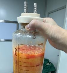 沁阳水动力吸脂手术要做多久？
